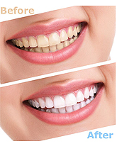 Bleaching & Veneers - Barta-Sima Dental Care